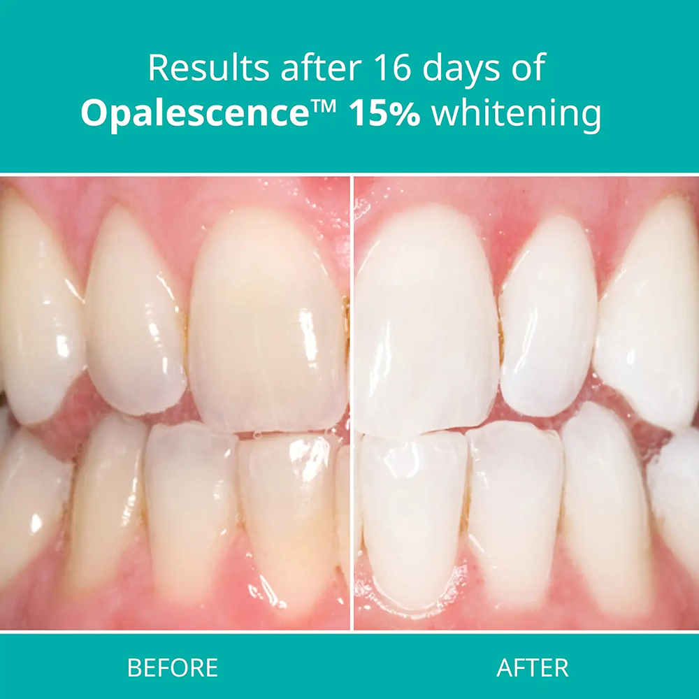 Opalescence Professionele Whit - Teeth Whitening Gel Opalescence recensie en prijs