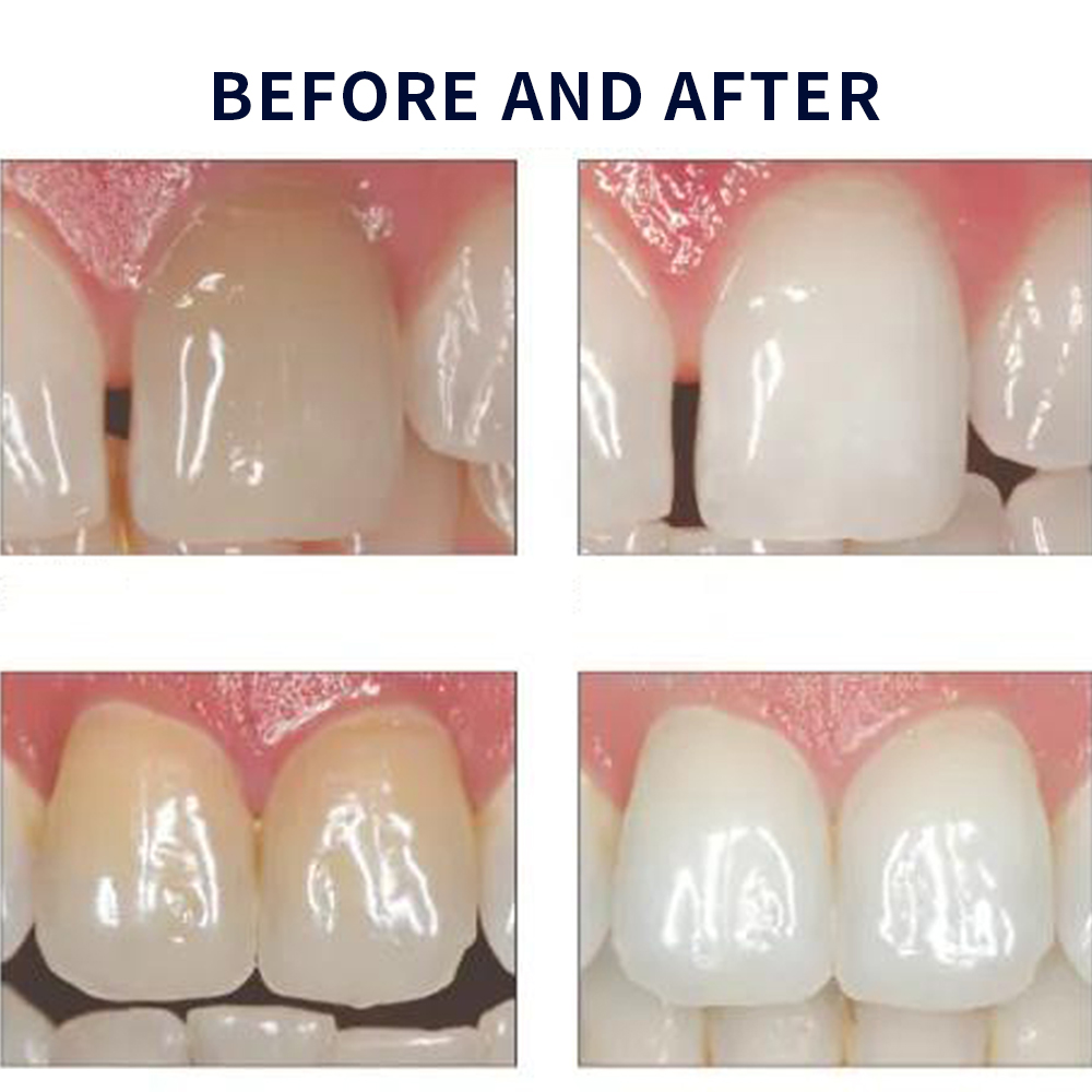 Opalescentie Whitening 20% Pf  - Teeth Whitening Bleaching Kit recensie en prijs