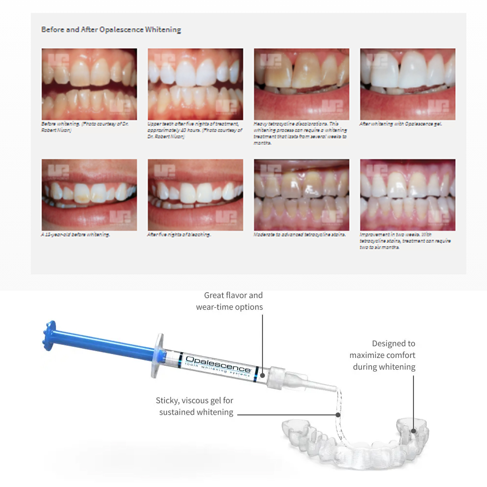 Opalescentie Whitening 20% Pf  - Teeth Whitening Bleaching Kit recensie en prijs