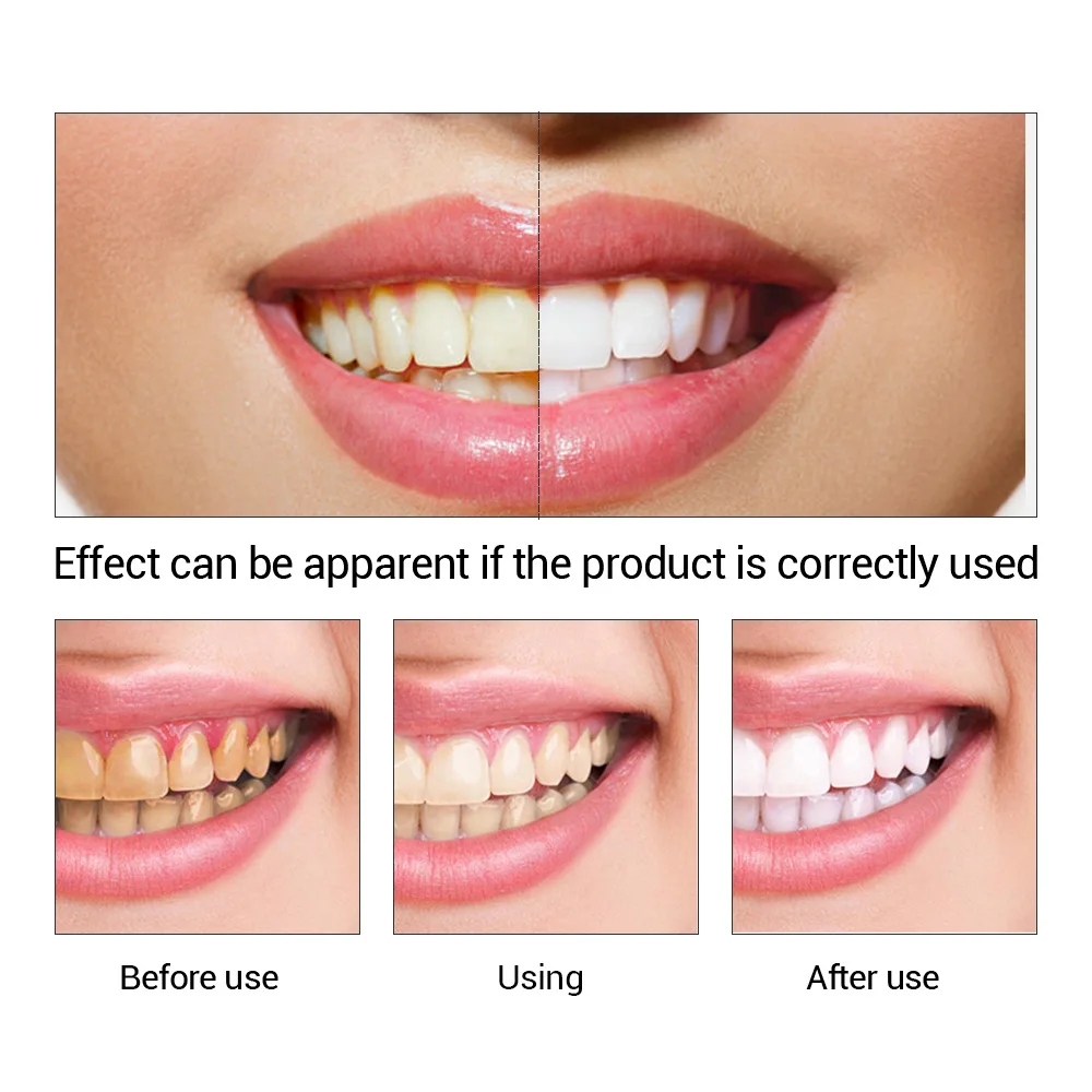 Fteenply Tanden Whitening Esse - Teeth Whitening Natural recensie en prijs