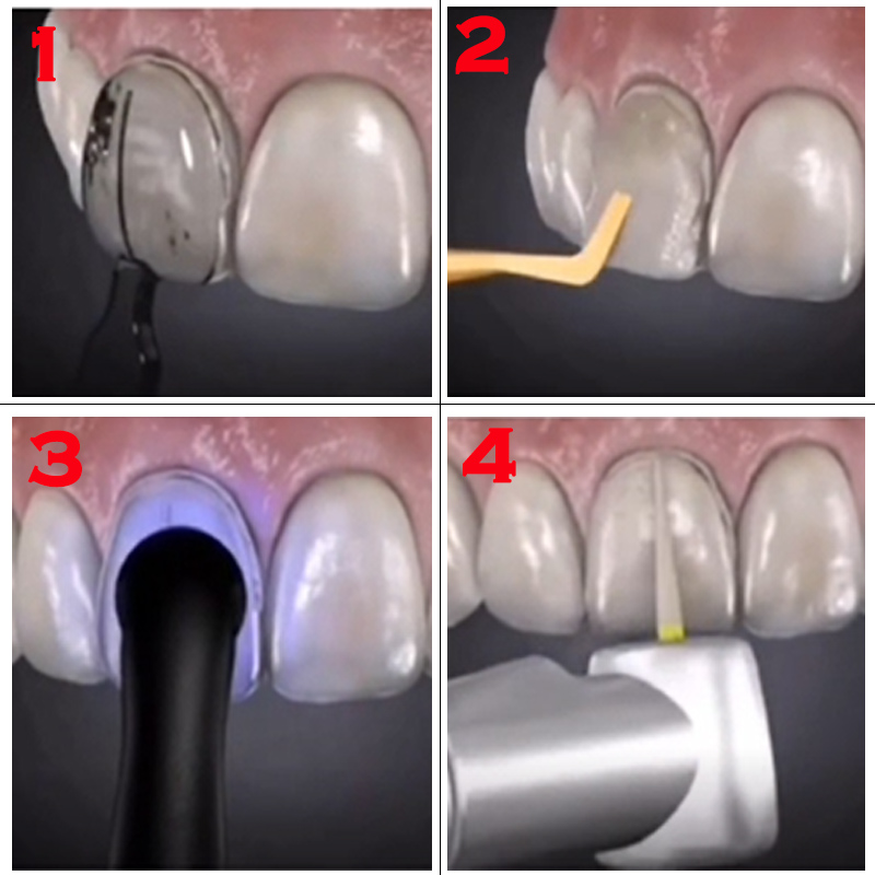 Tandheelkundige mal voor compo - Teeth Whitening Lab recensie en prijs