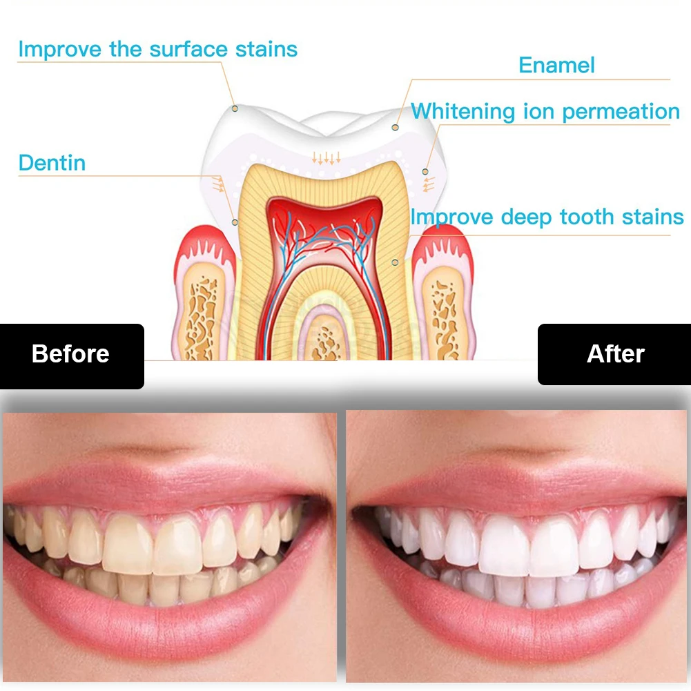 Tandheelkundige Tanden Whiteni - Teeth Whitening Bleaching Kit recensie en prijs