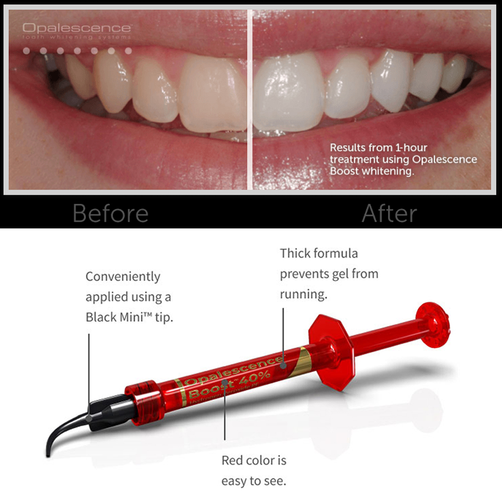 Ultradent Opalescence Boost PF - Teeth Whitening Gel Opalescence recensie en prijs